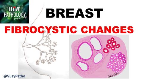 Diseases Of Breast Part 1 Normal Anatomy Classification