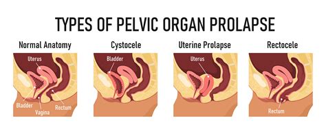 Pelvic Floor Physical Therapy For Pelvic Organ Prolapse Understanding