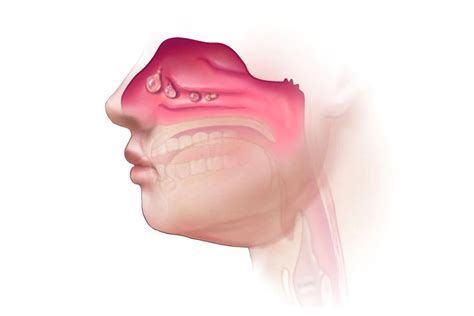 Nasal Polyposis Northern Valley Allergy