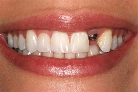 Implante Dentário Implantodontia Ortomix Odontologia Seu Dentista
