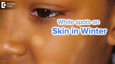 White Spots On Face In Winter Causes Prevention And Treatment Dr