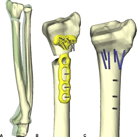 Image Guided Distal Radius Osteotomy Using Patient Specific Instrument