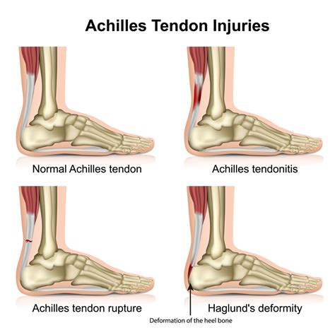 Tendonitis As Related To Achilles Tendinitis Pictures