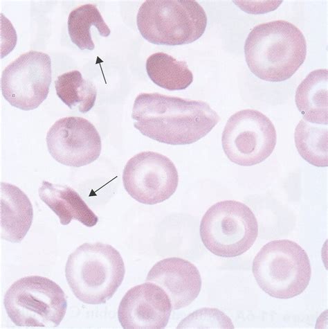 Hemoglobin C Diease And Trait Laboratory Diagnosis Medical Laboratories