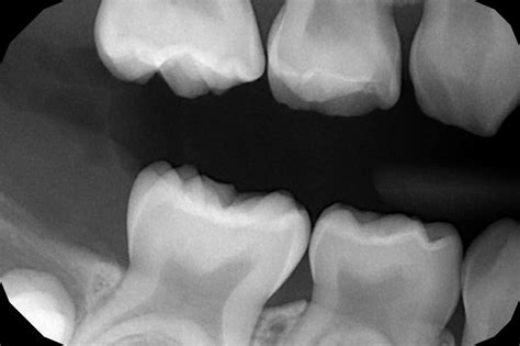 dental  rays   tooth pediatric dental blog