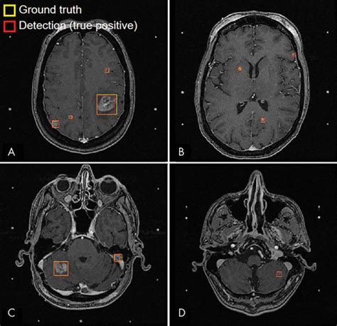 Computer Aided Detection Of Brain Metastases In T1 Weighted Mri For