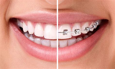 Ortodoncia Una especialidad con tratamientos cada vez más utilizados Clínica Dental Denty Smile
