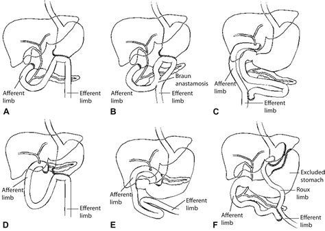 Devices And Techniques For Ercp In The Surgically Altered Gi Tract