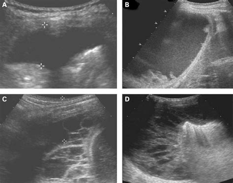 Ultrasound Staging Of Empyema A Grade 1 Effusion Showing Anechoic