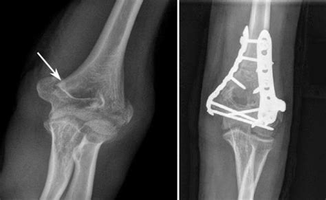 Distal Humerus Fractures Of The Elbow Orthoinfo Aaos 2023 Otosection