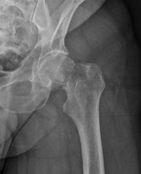 Ap Hip Radiograph Of A 79 Year Old With An Intracapsular Left Hip