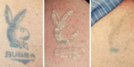 Keep in mind, however, that how fast your tattoo disappears depends on its color pigments, depth, and age. Is Laser Treatment Effective For Tattoo Removal ...