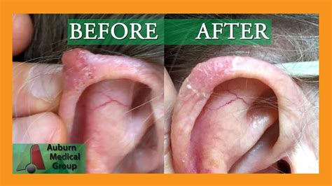 Before And After Basal Cell Carcinoma Biopsy On The Ear Auburn
