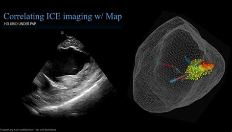 Processo do bes parado há oito meses. Advisor HD Grid Mapping Catheter, SE Case Library | Abbott