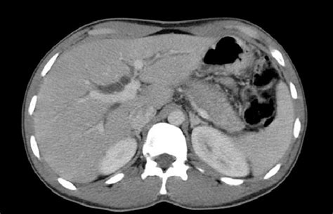 Pancreatic Ct Scan General Dilatation Of The Intrahepatic Biliary Tree