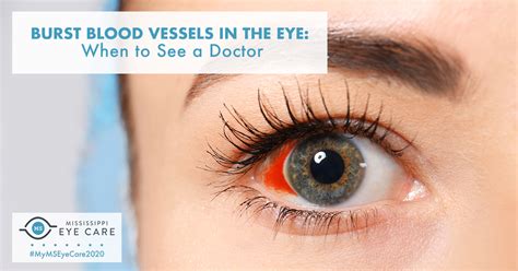 Blood Vessel Burst In Eye Connectionlasopa