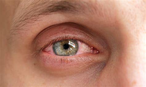 Pink Eye Symptoms Treatment Eduardo Besser MD