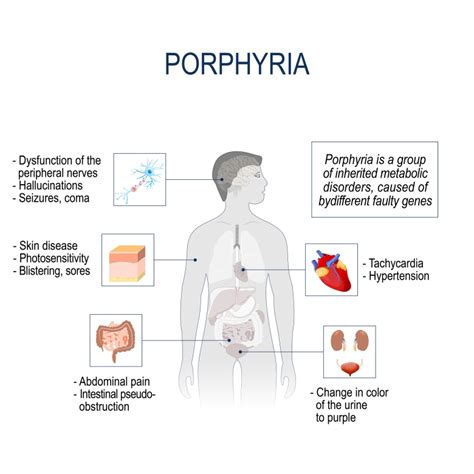 What Is Porphyria Types Causes Symptoms Treatment