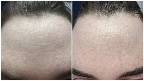 [before And After] 5 Month Improvement On My Forehead Wrinkles R Skincareaddiction