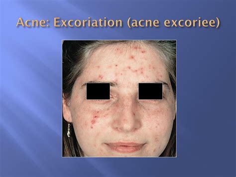 Ppt Implementing The Acne Care Pathway Powerpoint Presentation Free