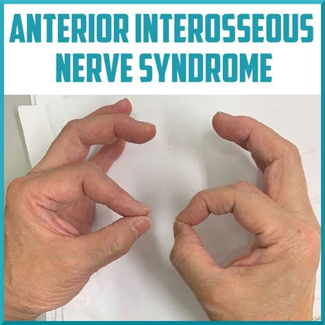 Overview Of The Anterior Interosseous Nerve Syndrome