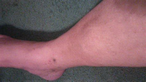 Lower Right Calf Showing Large Lump On Shin Foot Pics Calves Legs