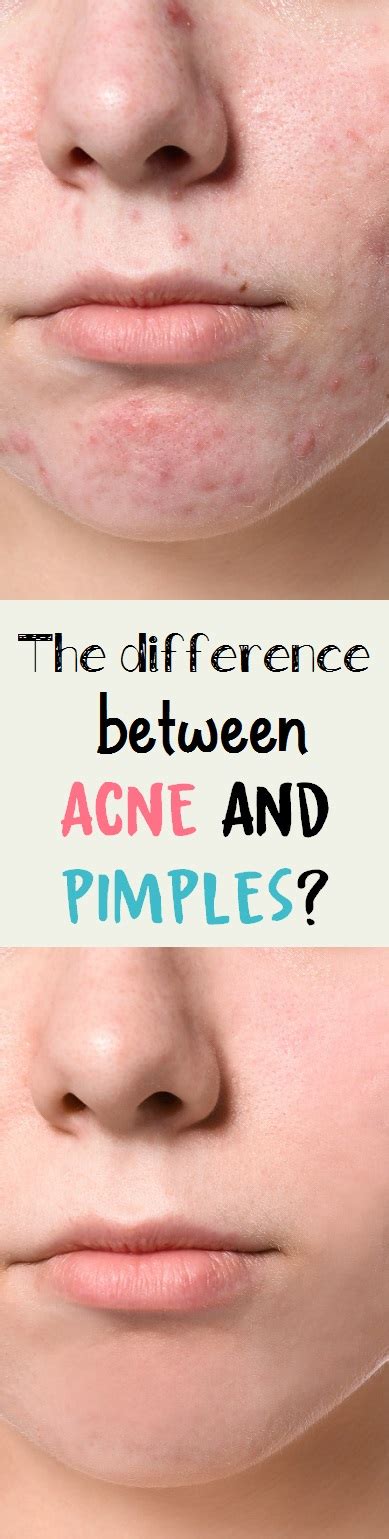 What Is The Difference Between Acne And Pimples How To Beauty