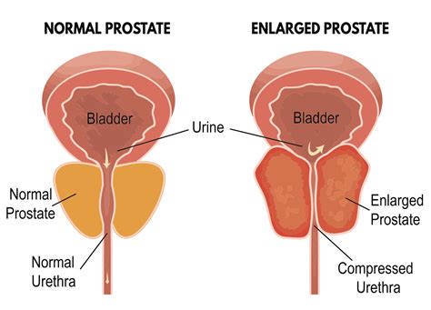 Why Men Dont Like To Talk About Their Enlarged Prostate