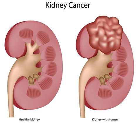 Kidney Cancer Causes Symptoms Signs Stages And Treatment