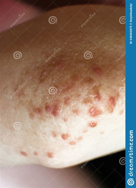 Rash On The Elbow Close Up Red Rash On The Arm Stock Image Image Of