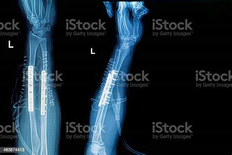 Xray Image Of Forearm With Implant Stock Photo Download Image Now