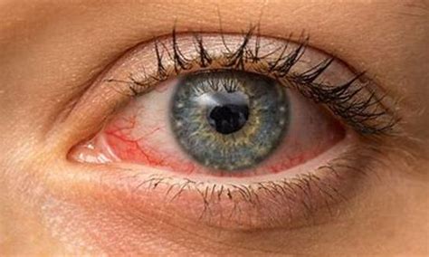Homeopathy And Conjunctivitis Pink Eye
