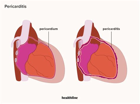 Pericarditis Symptoms Treatment Causes Diagnosis More