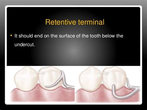 T Clasp Kennedy Class I And Ii Undercut Locate Adjacent Edentulous Area