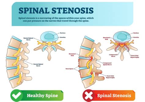 Cervical Stenosis Trimed Spine And Joint