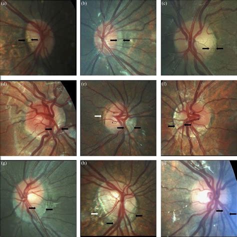 Choroidal Crescent Optic Nerve