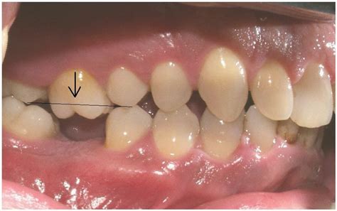 Perawatan saluran akar dapat didefinisikan sebagai mengeluarkan seluruh pulpa gigi yang rusak. KLINIK PERGIGIAN SYARIFAH: Kenapa perlu ganti gigi yang ...