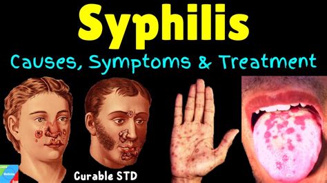Syphilis Symptoms Causes Pathophysiology Diagnosis Treatment