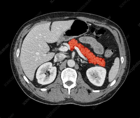 Normal Abdominal Organs Ct Scan Stock Image C0147035 Science