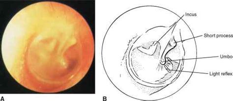 Inspect The Tympanic Membrane Physical Diagnosis