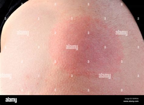 Erythema Hi Res Stock Photography And Images Alamy