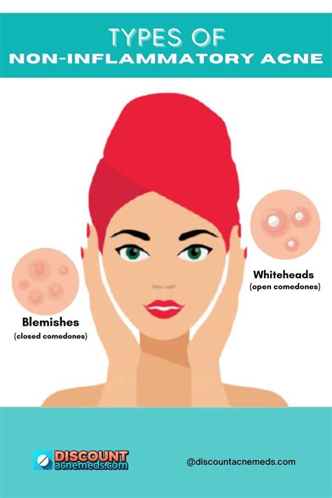 Types Of Non Inflammatory Acne Oily Skin Acne Closed Comedones