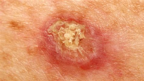 Skin Cancer Couse Type Treatment And Nursing Management