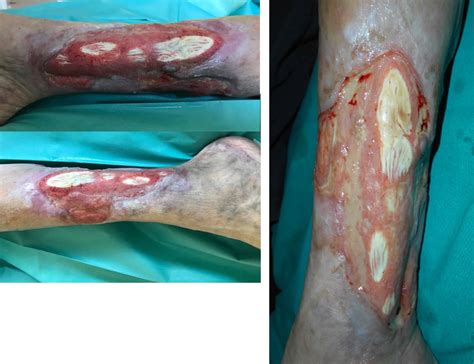 Vac Ulta To Prepare Lesion Bed For Skin Graft In Extensive Leg Ulcers