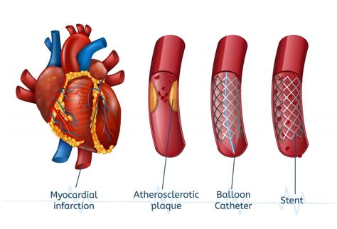 What Is Angioplasty