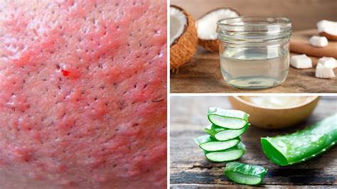How To Cure Folliculitis At Home
