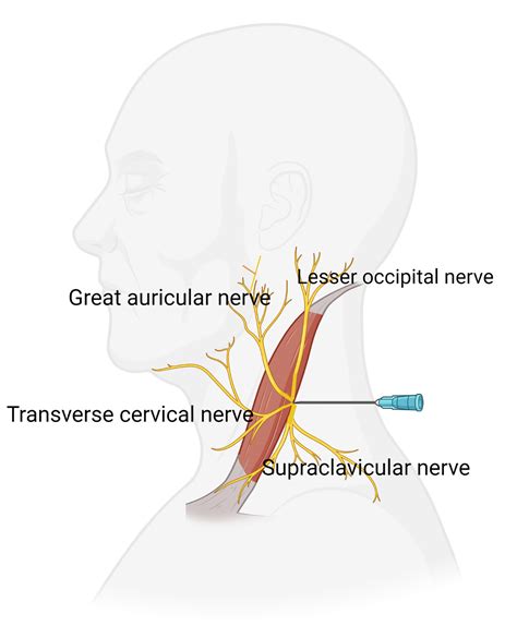 Superficial Cervical Plexus Block Mnemonic Epomedicine Porn Sex Picture