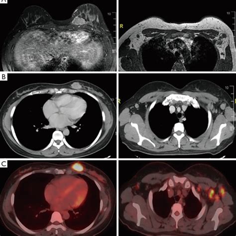 The Images Of Breast And Axillary Lymph Nodes Mri A Ct B And