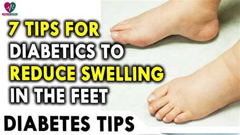 Diabetes Symptoms Feet Swelling