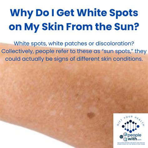 Peoplewith News Why Do I Get White Spots On My Skin From The Sun